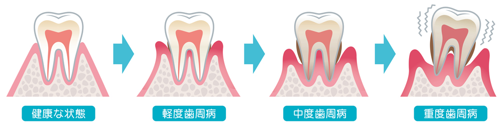 歯周病