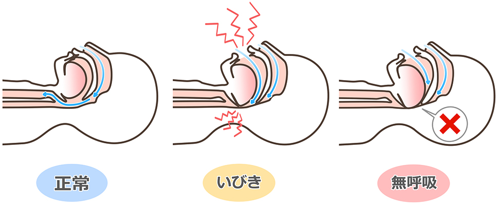 睡眠時無呼吸症候群